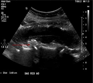 Anévrisme de l'aorte abdominale (échographie)
