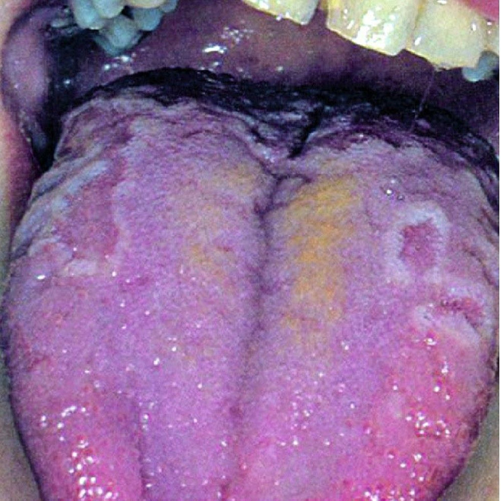 Geographic Tongue