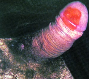 Erythroplasie de Queyrat mit Carcinoma in situ