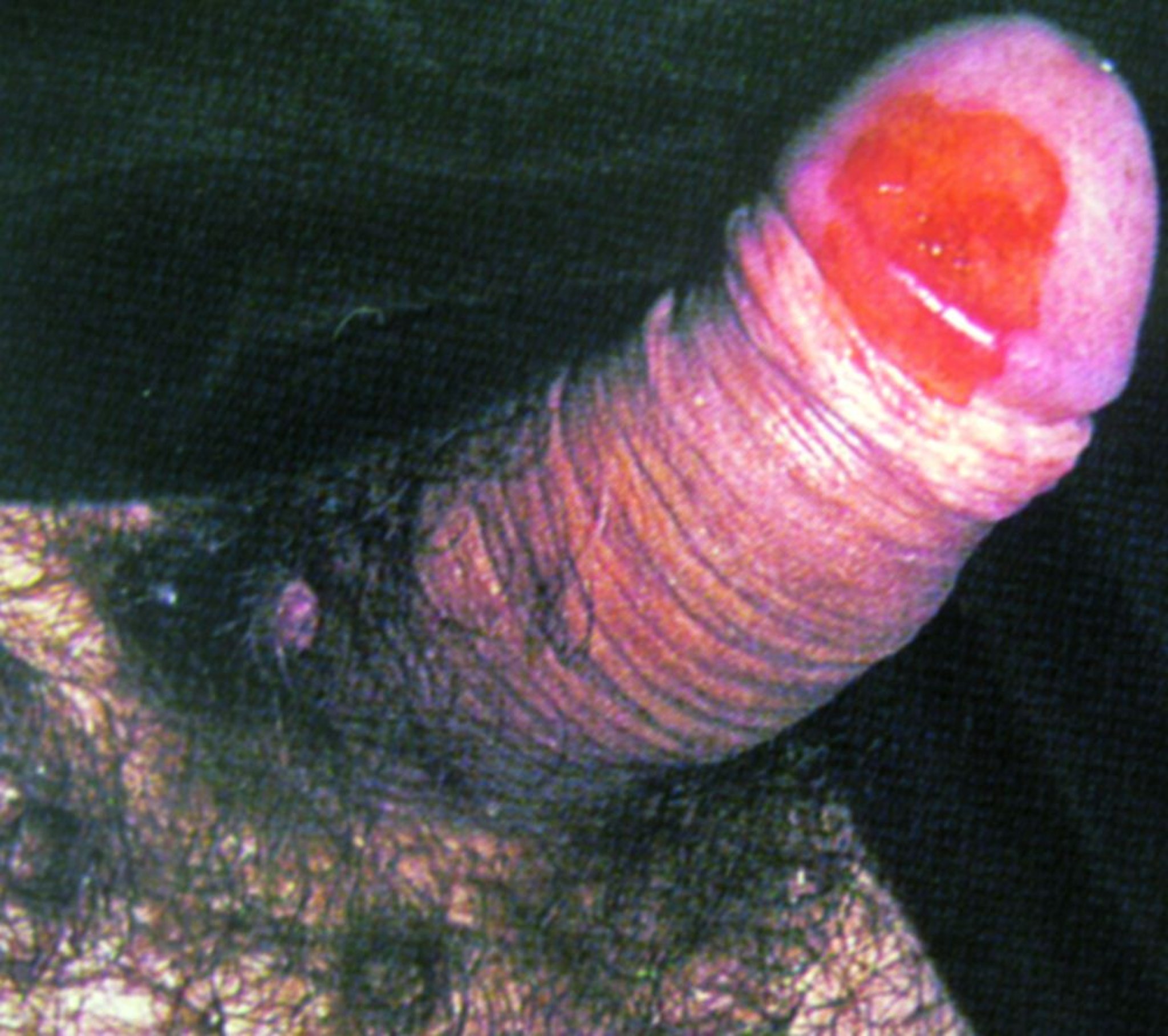 Eritroplasia di Queyrat con carcinoma in situ