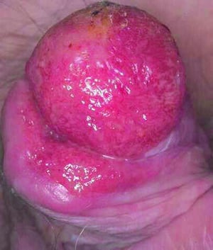 Eritroplasia di Queyrat con cancro del pene