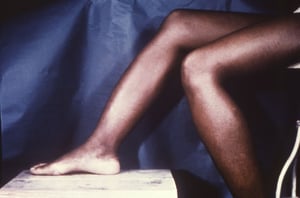 Tibia a sciabola