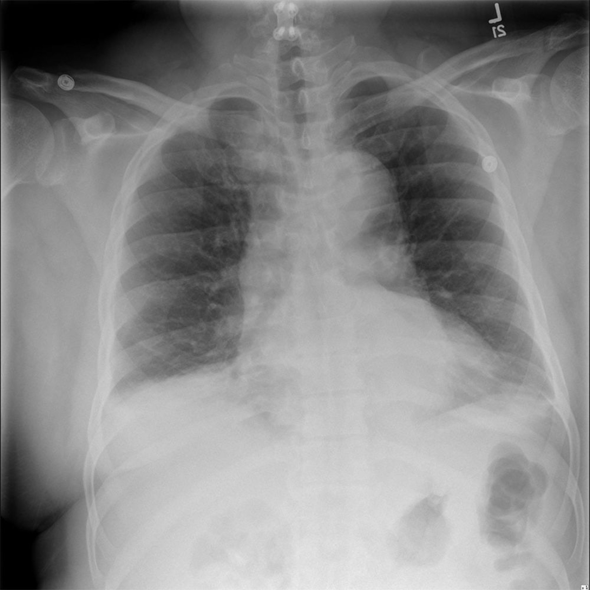 Widened Mediastinum