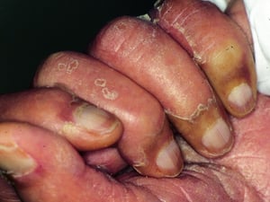 Uñas de Terry