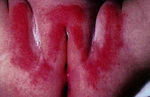 Dermatitis en W