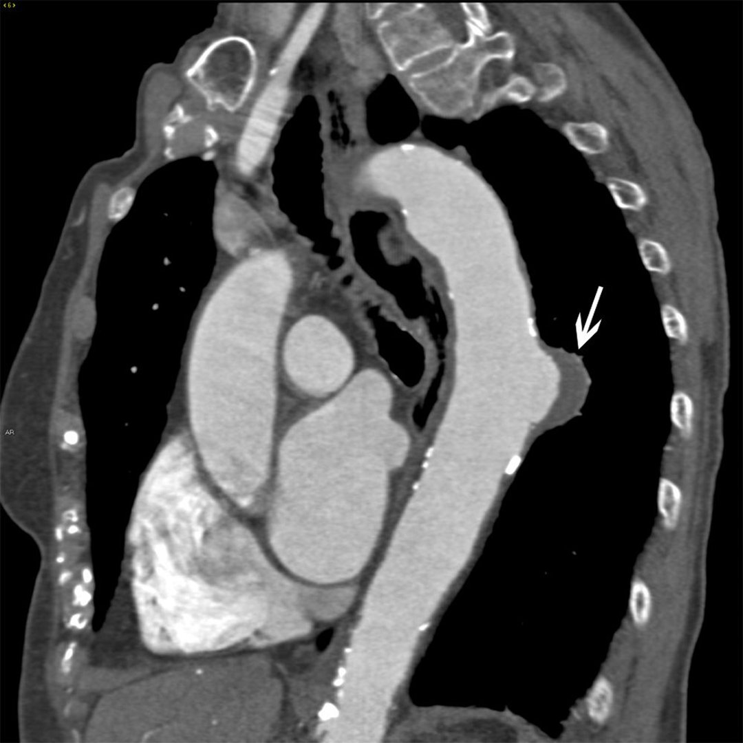 Aneurismas da aorta torácica - Doenças cardiovasculares - Manuais MSD ...