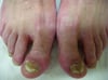 Tinea pedis mit dorsalen Fußschuppen