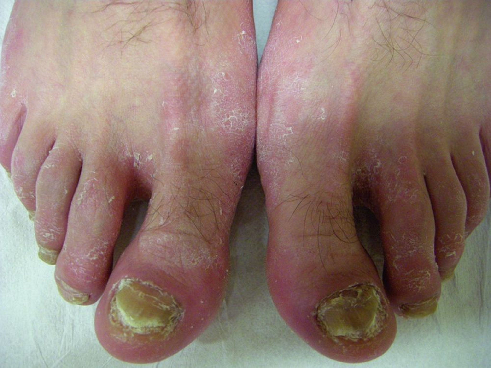 Tinea pedis con squame sul dorso del piede