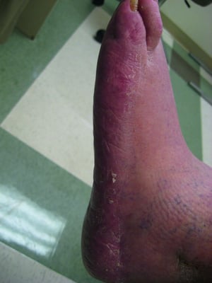 Tinea pedis mit Schuppung und Erythem des lateralen Fußes