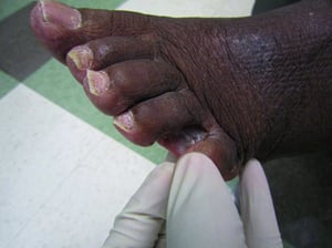 Tiña del pie en un paciente con piel oscura