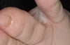 Subtile Tinea pedis