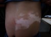 Vitiligo segmentario en el tronco