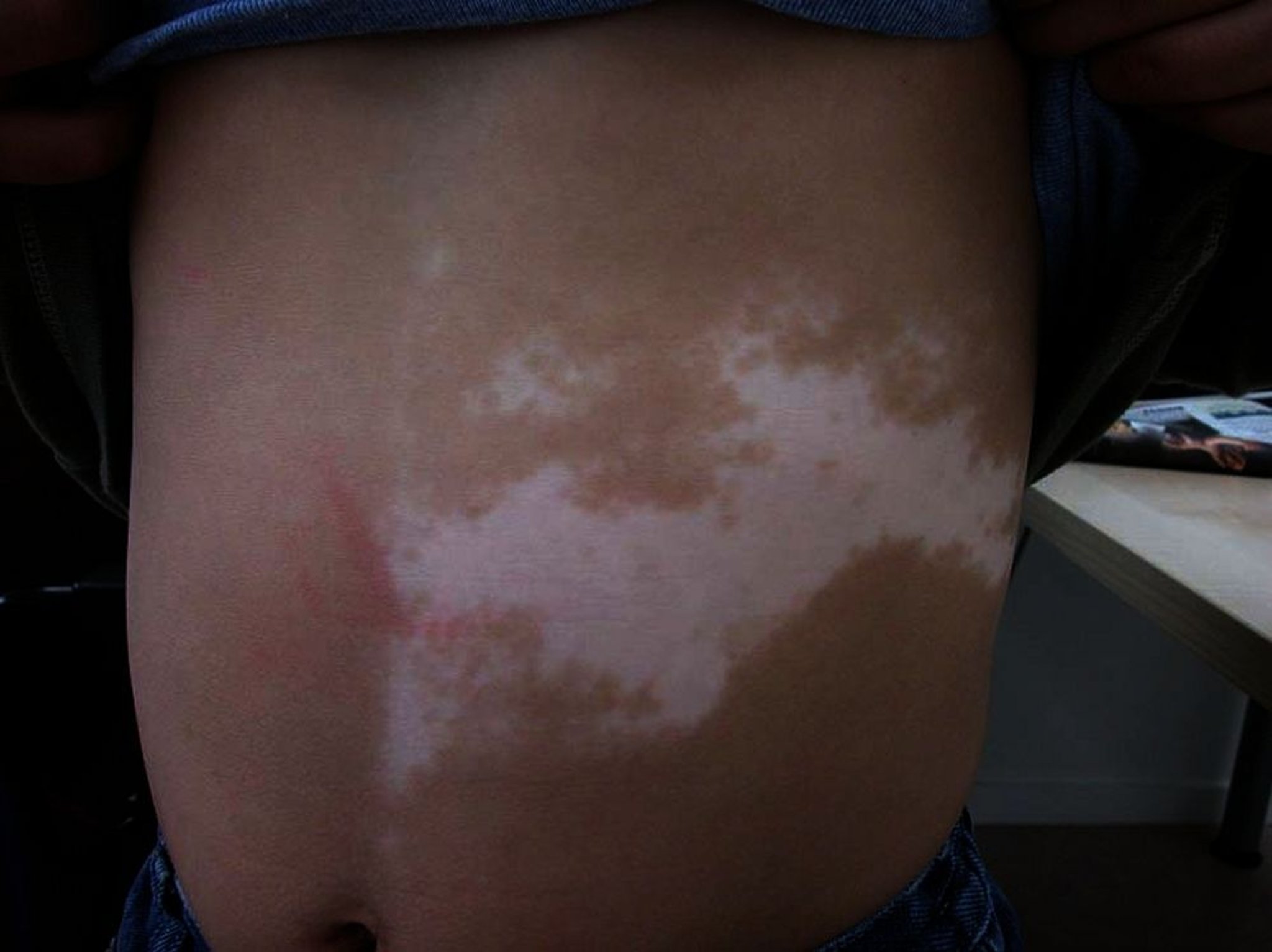 Vitiligo segmentar no tronco