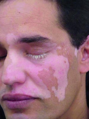 Segmental Vitiligo of the Face