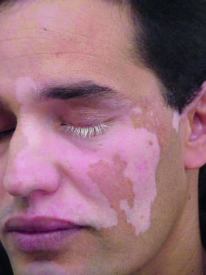 Segmentale Vitiligo des Gesichts