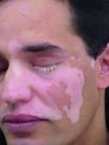 Vitiligo segmentario de la cara