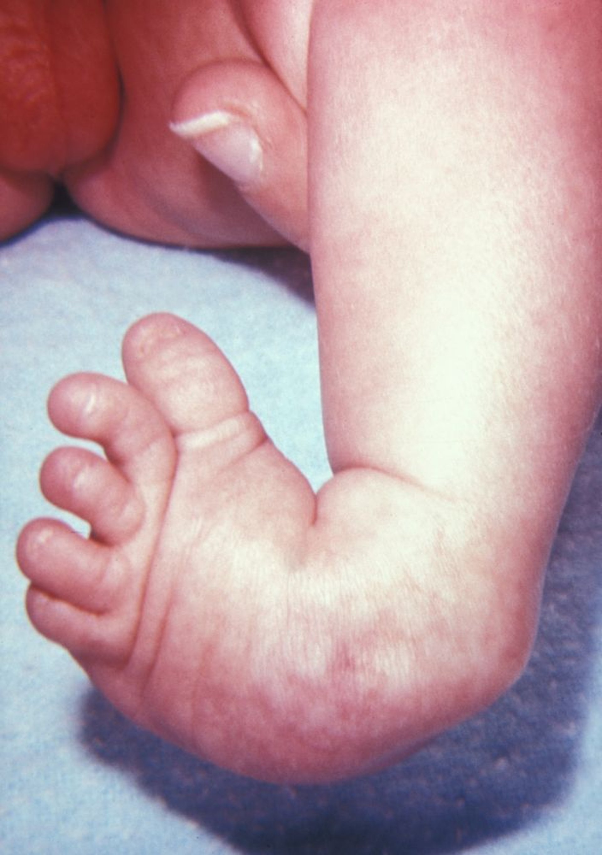 VACTERL (anomalie vertebrali, atresia anale, malformazioni cardiache, fistola tracheoesofagea, atresia esofagea, anomalie renali e aplasia radiale, e altre anomalie degli arti) (anomalie delle gambe)