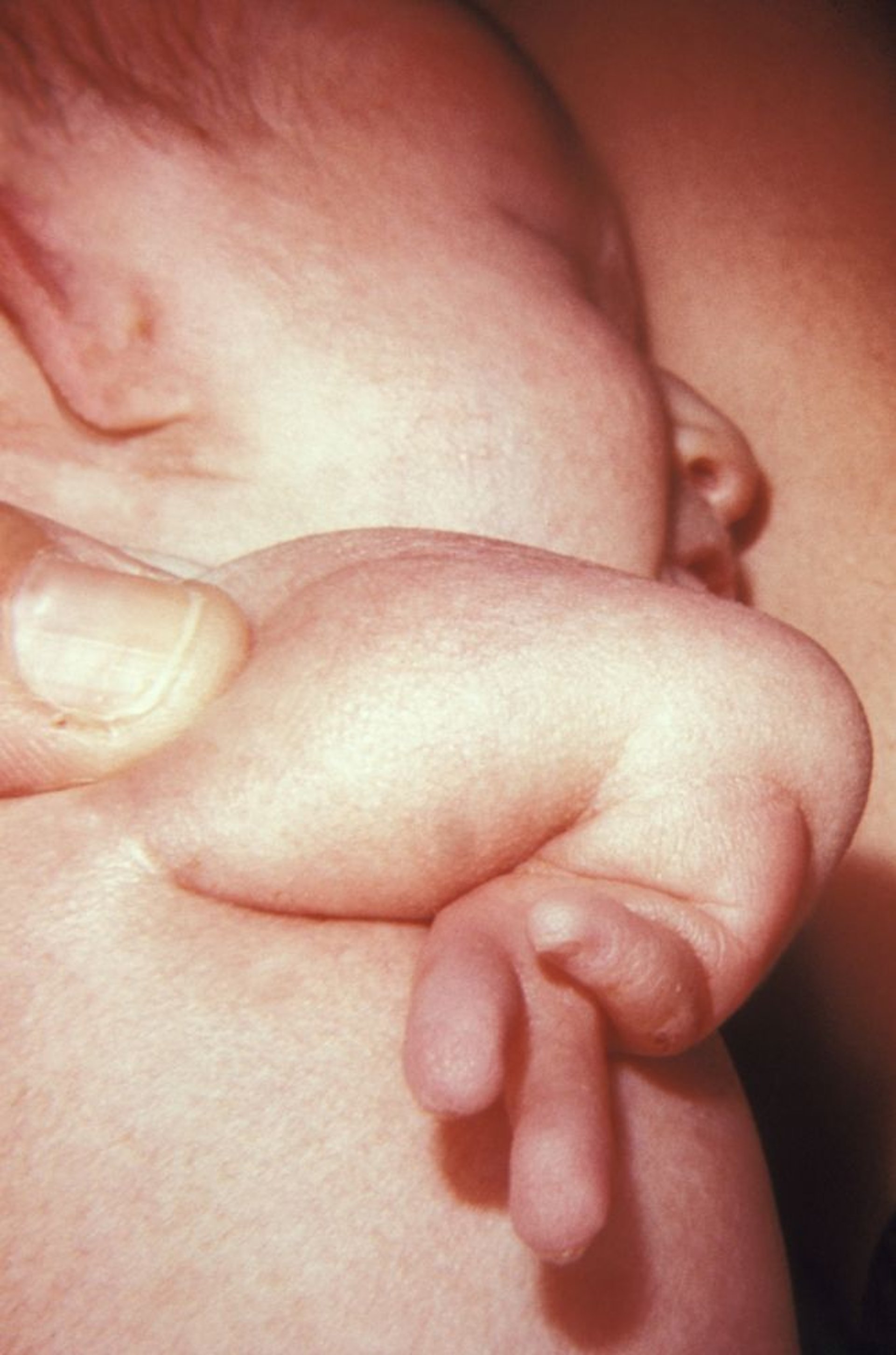 VACTERL (anomalie vertebrali, atresia anale, malformazioni cardiache, fistola tracheoesofagea, atresia esofagea, anomalie renali e aplasia radiale, e altre anomalie degli arti) (anomalie delle braccia)