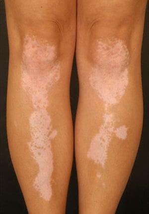 Vitiligo simétrico en las piernas