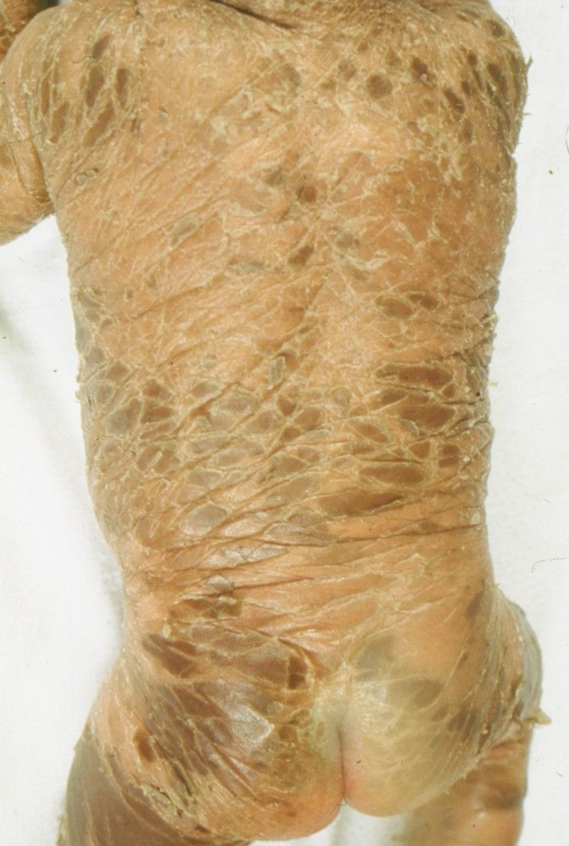 Severe Lamellar Ichthyosis in a Child
