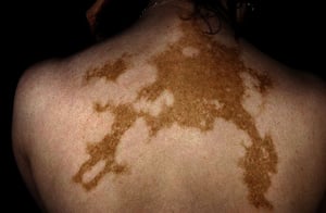 Vitiligo universal en la espalda