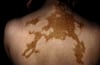 Vitiligine diffusa sul dorso