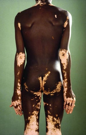 Vitiligo kontrastiert mit dunkler Haut