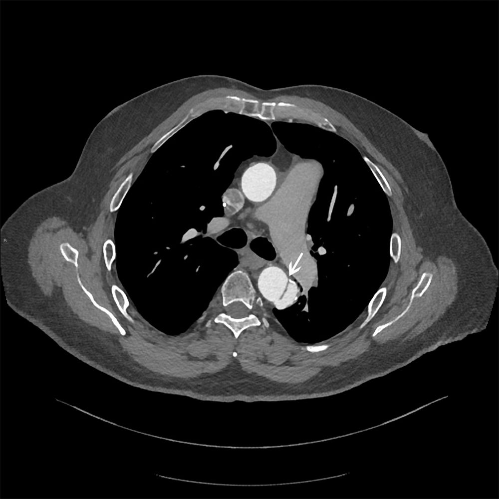 Dissection aortique - Cardiologie - Édition professionnelle du Manuel MSD