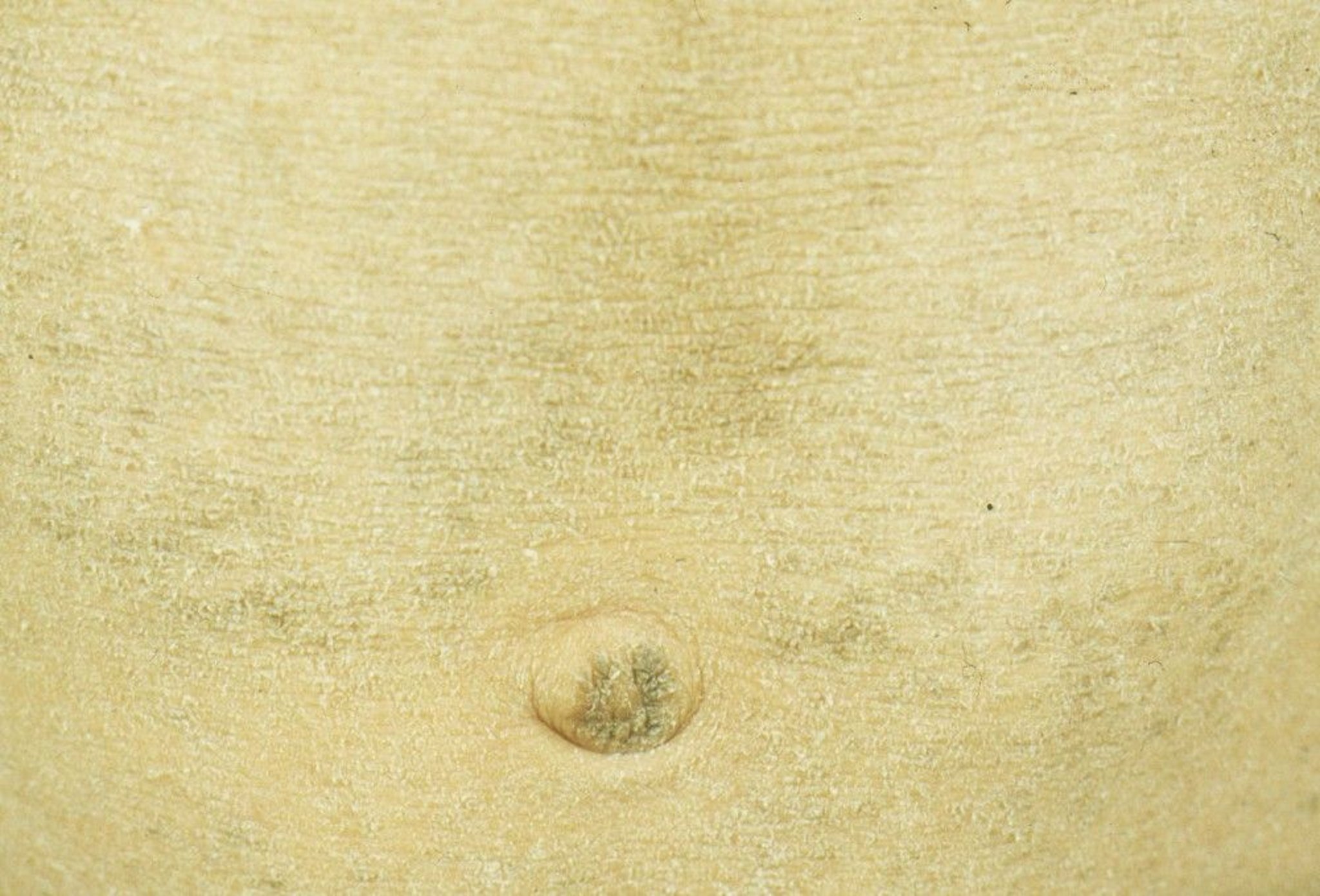 Ichthyosis Vulgaris on the Abdomen