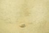 Ichthyosis vulgaris am Abdomen