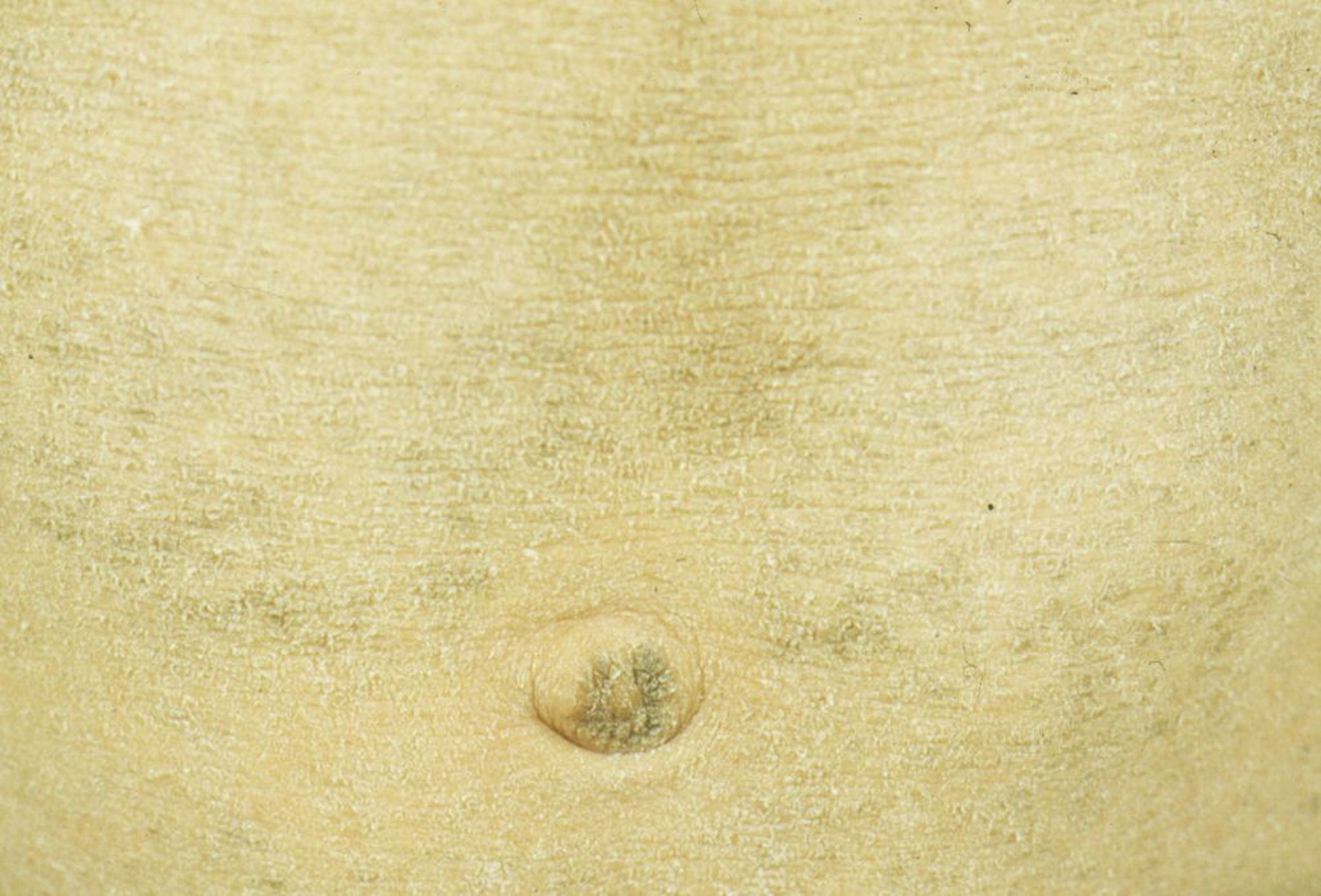 Ictiosis vulgar sobre el abdomen