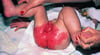 Acrodermatitis enteropathica mit schwerer perianaler und perinealer Dermatitis