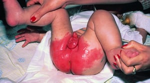 Acrodermatitis enteropática con dermatitis perianal y perineal grave