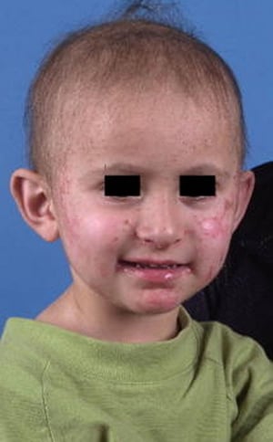 Acrodermatite enteropatica in un bambino