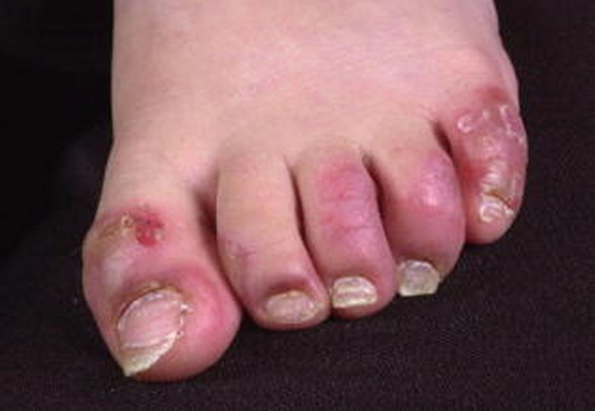 Acrodermatitis enteropathica mit Paronychie