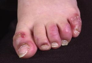 爪囲炎を伴う腸性肢端皮膚炎