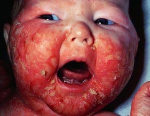Acrodermatite enteropática com dermatite facial grave