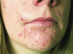 Acne con pustole multiple