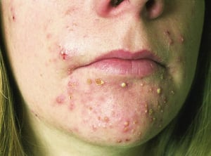Acne com múltiplas pústulas
