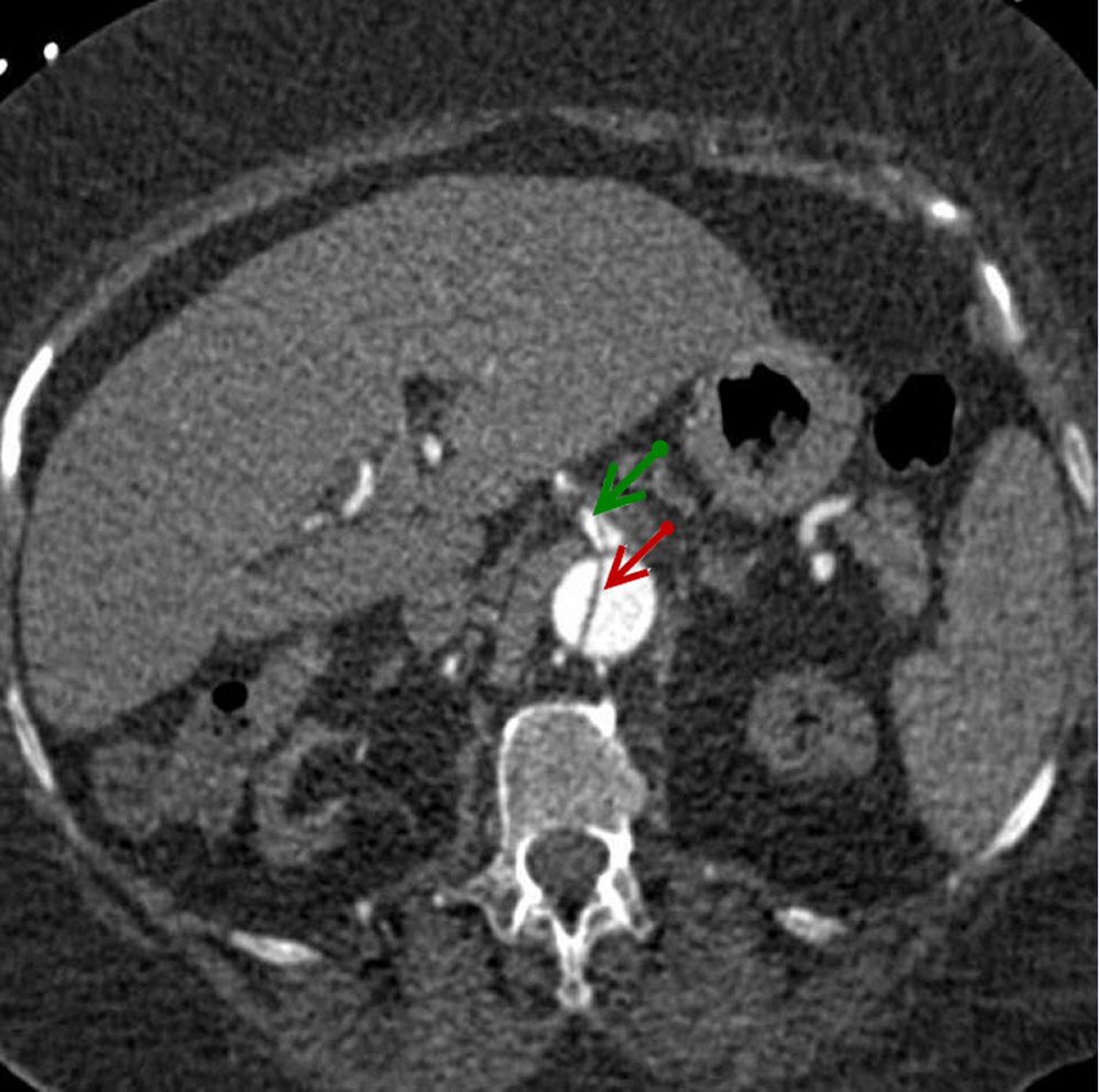 Abdominal Aortic Dissection