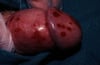 Balanitis cercenada secundaria a artritis reactiva