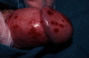 Balanitis cercenada secundaria a artritis reactiva
