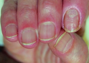 Chronic Paronychia of Second (Index) Fingernail