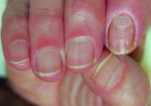 Chronische Paronychie des zweiten Fingernagels (Zeigefinger)
