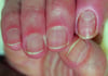 Chronic Paronychia of Second (Index) Fingernail