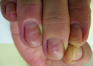 Chronische Paronychie mit geschwollener proximaler Nagelfalte und Nagelhautverlust