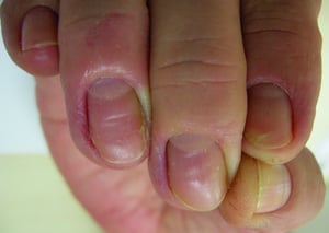 後爪郭の腫脹および爪上皮の消失を伴う慢性爪囲炎