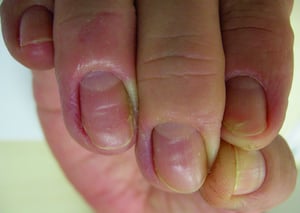 Хроническая паронихия с опухшим проксимальным ногтевым валиком и потерей кутикулы