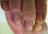 Viêm mé móng mạn tính có nếp gấp móng đầu gần sưng lên và mất lớp biểu bì