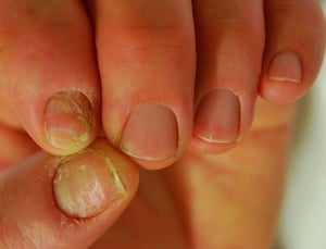 Chronische Paronychie mit Schwellung der Nagelplatte, Fehlen der Nagelhaut und Abnormalitäten der Nagelplatte